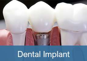 Dental Implants