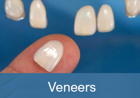 Veneers
